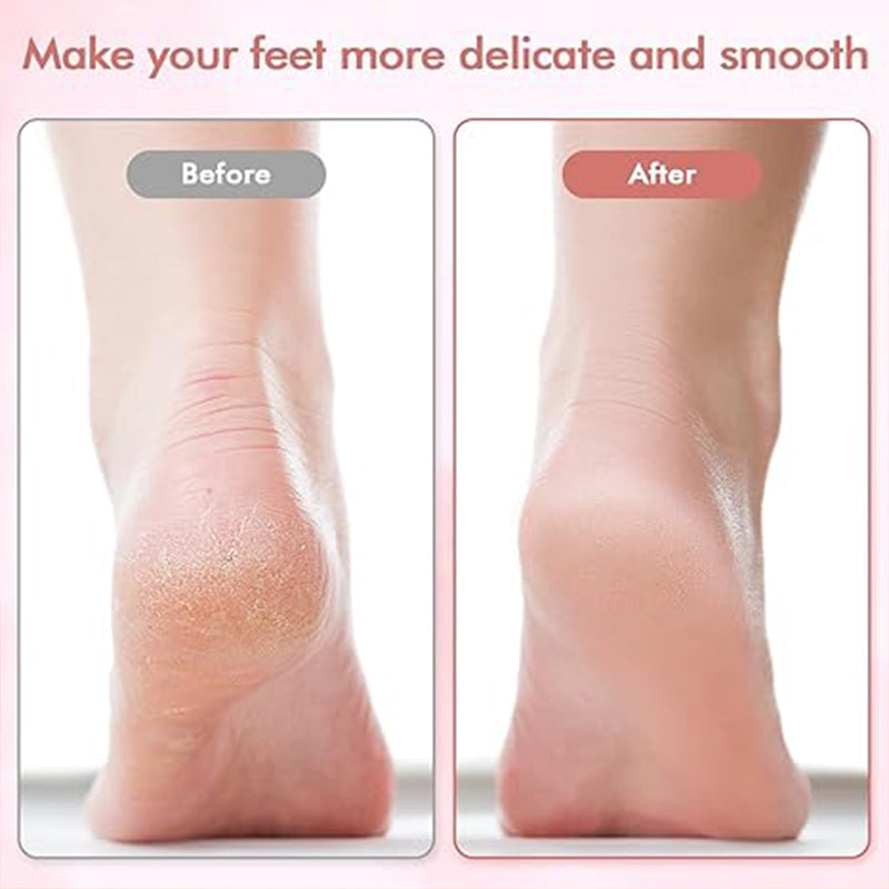 🔥Limited Time Sale - Get 30% Off🔥 Electric Feet Callus Remover 💖[+ FREE Head! 🎁]