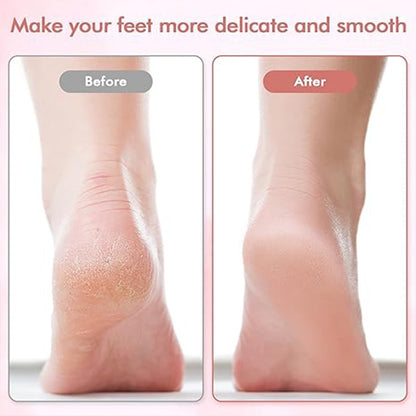 🔥Limited Time Sale - Get 30% Off🔥 Electric Feet Callus Remover 💖[+ FREE Head! 🎁]
